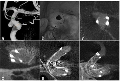 The Enterprise2 Stent for Endovascular Treatment of Intracranial Aneurysms: Short-Term Results From a Single Center Experience